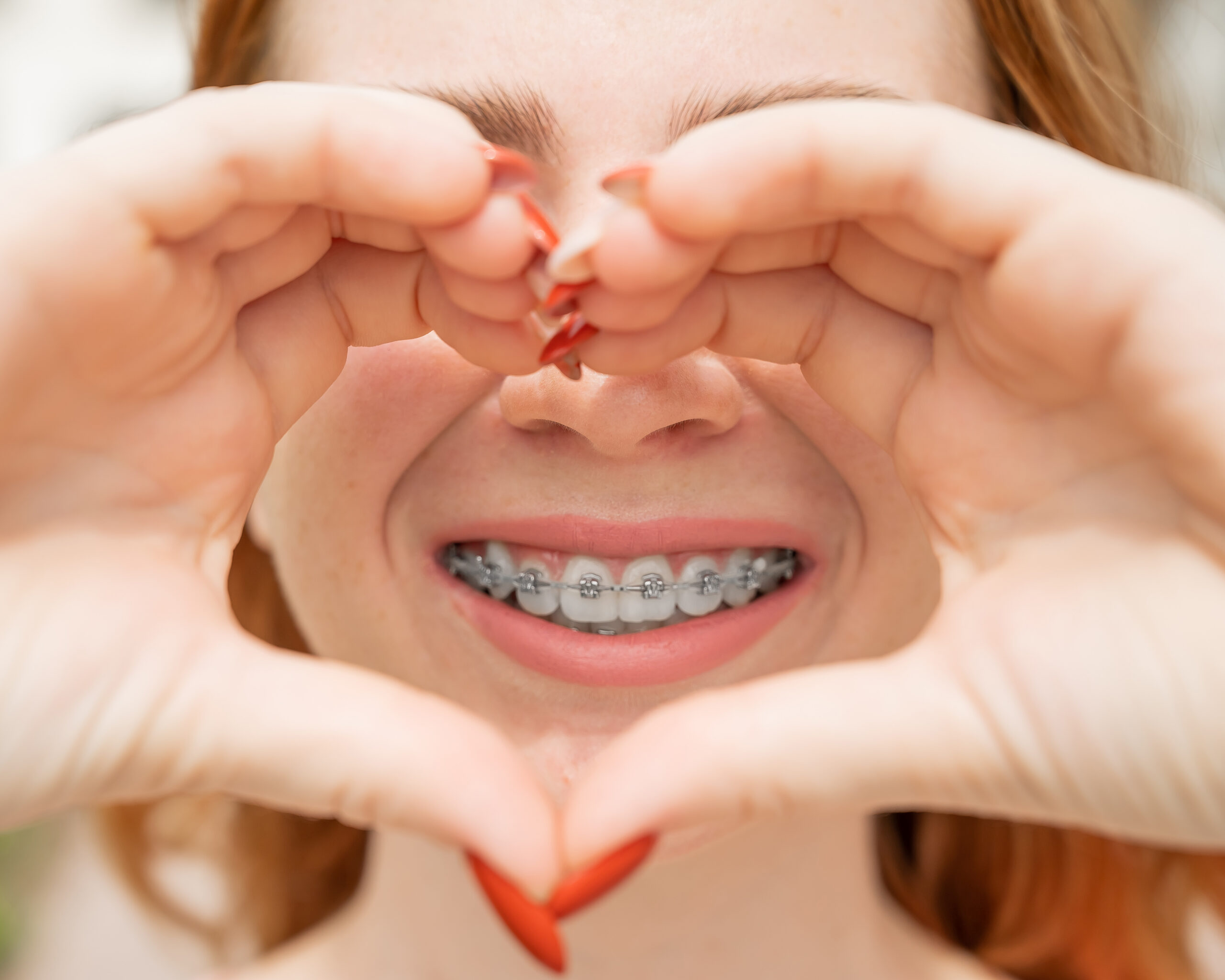 Close-up,Portrait,Of,A,Young,Red-haired,Woman,With,Braces,On Patient with metal braces from an orthodontist in Park Ridge IL.